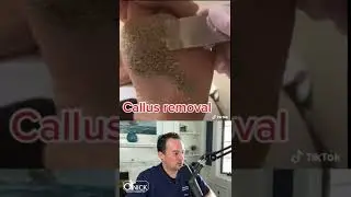 DOCTOR REACTS TO CALLUS REMOVAL! 😱 #shorts #reaction