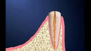 Over Denture - Miskin Ajax Dental