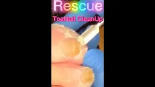 Part One (Right Foot) Rescue ToeNail CleanUp Must Watch!
