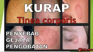 KURAP (Ringworm) - Penyebab, Gejala dan Pengobatan KURAP