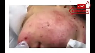 TOP 100 PIMPLE POPING & BLACKHEAD REMOVAL 2022 SATISFYING | BUSTYPOPER