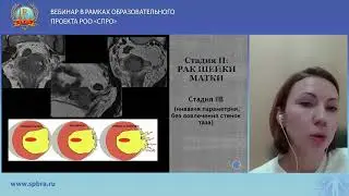 Cтадирование рака шейки матки c помощью МРТ. Обновленные рекомендации ESUR