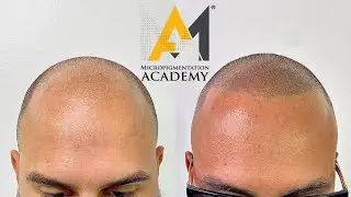 Scalp Micropigmentation viewed outside in natural sunlight