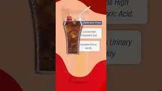 Beer Myth | Kidney Stone Disease | Urology | Dr Vinod Kumar P | NU Hospitals