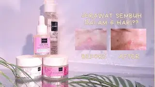 REVIEW SCARLETT ACNE FACIAL WASH + ACNE SERIES NYA , JERAWAT SEMBUH DALAM 6 HARI???