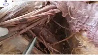 Demonstartion of axillary artery and brachial plexus