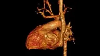 Persistent left superior vena cava (PLSVC)