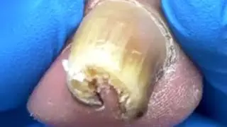 Amazing! Extremely curly ingrown toenails!【Pedicure Master Lin Jun】
