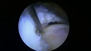 R Rotator Cuff repair with Biobrace graft 3 23 23 DS