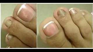 RECEITA PARA CLAREAR AS UNHAS ESCURAS + FUNGOS