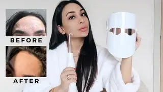 HOW I CLEARED MY SKIN | Fungal acne, rosacea, bumps