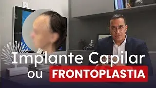 IMPLANTE CAPILAR X FRONTOPLASTIA: qual melhor opção para reduzir a testa em mulheres?