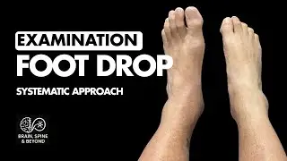 Foot Drop Differential Diagnosis: Is It Peroneal Nerve Injury OR a Lumbar Disc Prolapse?