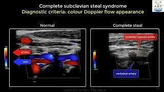 Complete Subclavian Artery Steal Syndrome  ultrasound criteria