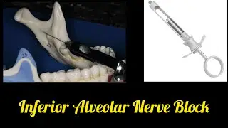 Inferior Alveolar Nerve Block clinical demonstration# dental lectures