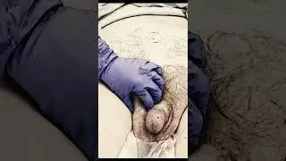 Spermatic Cord Nerve Block Demonstration