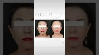 FACELIFT #youtubeshorts #facelift #plasticsurgeon