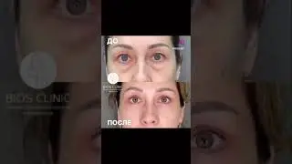 Пластика верхних век❤️ ДО✅ ПОСЛЕ ✅ 