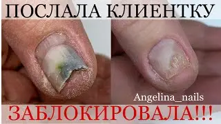 ОНИХОЛИЗИС / ПСЕВДОМОНИЯ / ДЕФОРМАЦИЯ НОГТЕЙ / заблокировала клиентку больше НЕ ПРИМУ !!!