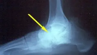 Possible Surgey (Always see a Doctor!)