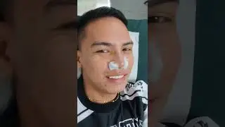 My Rhinoplasty Journey | Part 3