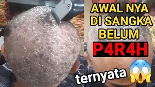 Ramai yang sepele kan penyakit ini akhirnya berakibat f4t4l (Diseases of the scalp).
