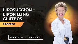 Liposucción completa + lipofilling glúteos