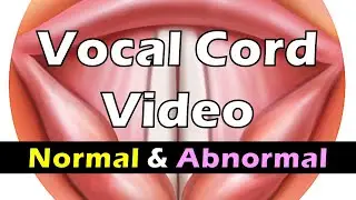 Vocal Cord Movement (Normal vs Abnormal)