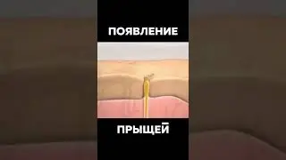 Как Появляются Прыщи 😲 