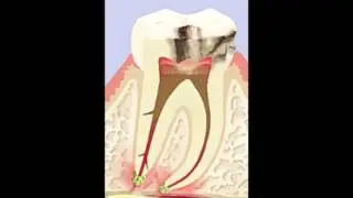 4 melhores dicas para curar dor de dente