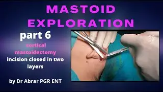 cortical mastoidectomy | incision closed in layers