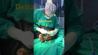 Delta frame(external fixator) for compound(open) fracture of ankle 