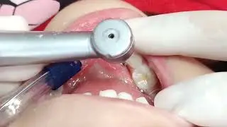 Odontopediatria e Restauração