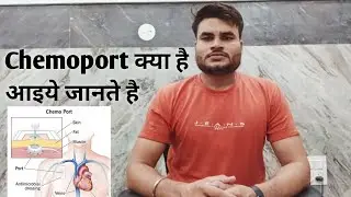 Chemoprts insertion | What is chemoport | types of chemoprts removal of chemoport chemoport क्या है