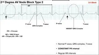 EKG Patterns | 1st & 2nd Degree AV Node Blocks