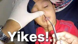 Something Weird Stuck in Boy's Nose | What is it?
