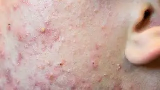 How to cure acne
