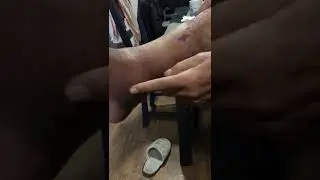 Осложнения после перелома и не правильной лечения.
