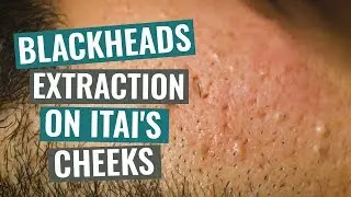 Blackheads extraction on Itai's cheeks