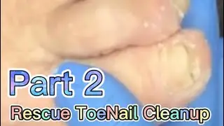Part 2 Rescue ToeNail CleanUp (Left Foot)