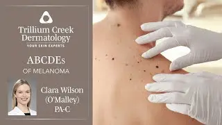 Learn the ABCDEs of Melanoma