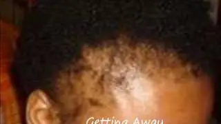 Tension Alopecia...How to stop balding by Naturallymea