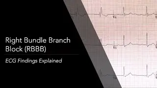 Right Bundle Branch Block (RBBB) ECG