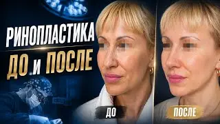 Ринопластика До и После