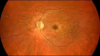 How Does Stargardt Disease Happen