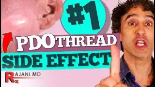 Thread Lift -Thread Lift Gone Wrong