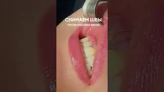 Через неделю после пластики десны удаляем нити и можем оценивать результат