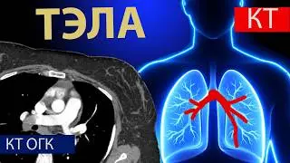 Лучевая диагностика ТЭЛА