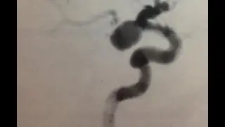 Aneurisma, la muerte silenciosa