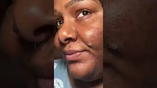 Pimple Patch Chronicles - moving to barbados & updates 🇧🇧 #acnepatch #omg #pimplepatch